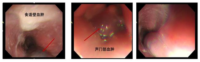 小異物，大后果 ——一個(gè)消化科醫(yī)生的日記(圖1)