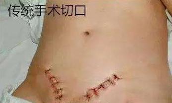 切口小，當(dāng)天即可生活自理——外三科開展腹腔鏡下疝氣手術(shù)(圖4)